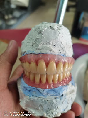 Gigi palsu veneer dan kawat gigi