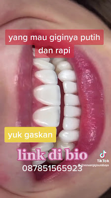Veneer gigi surabaya